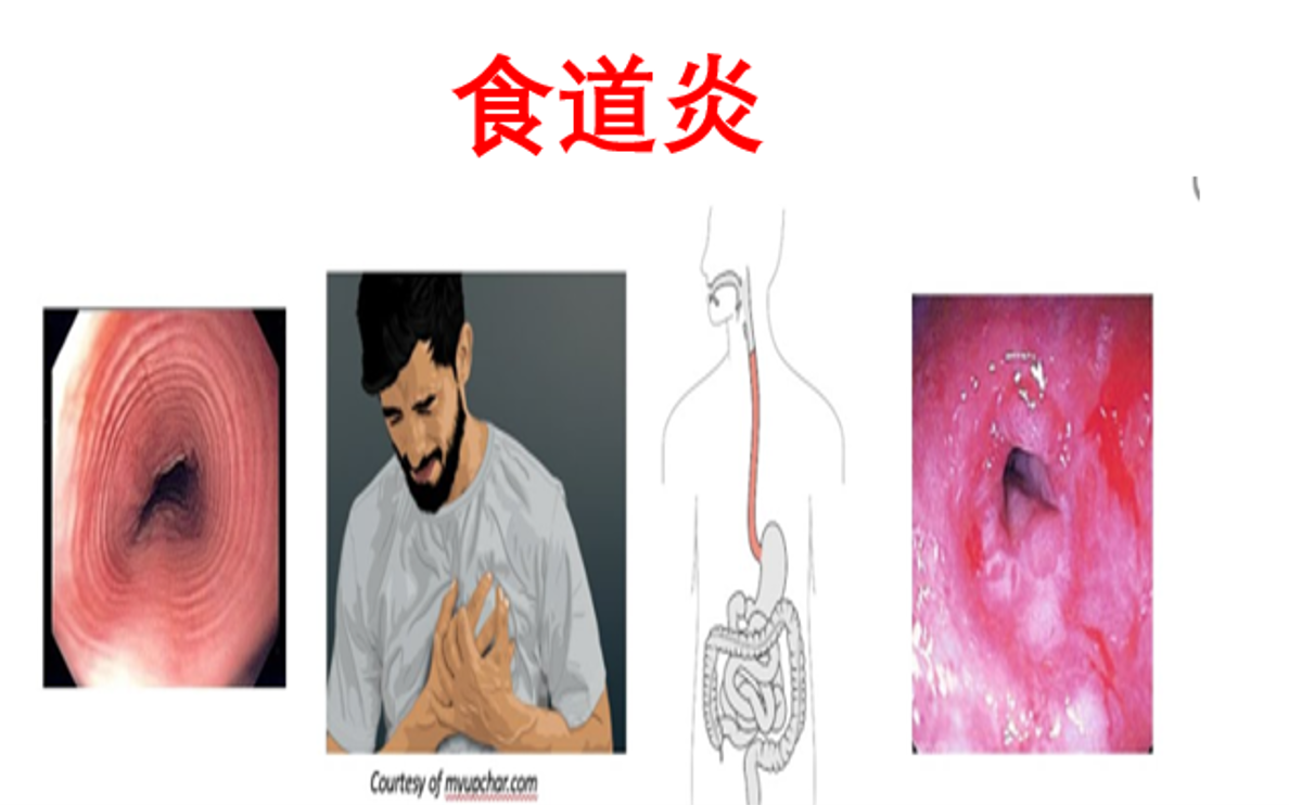 【医学科普】食道炎 反流烧心 消化内科 双语实用内科学课程系列哔哩哔哩bilibili