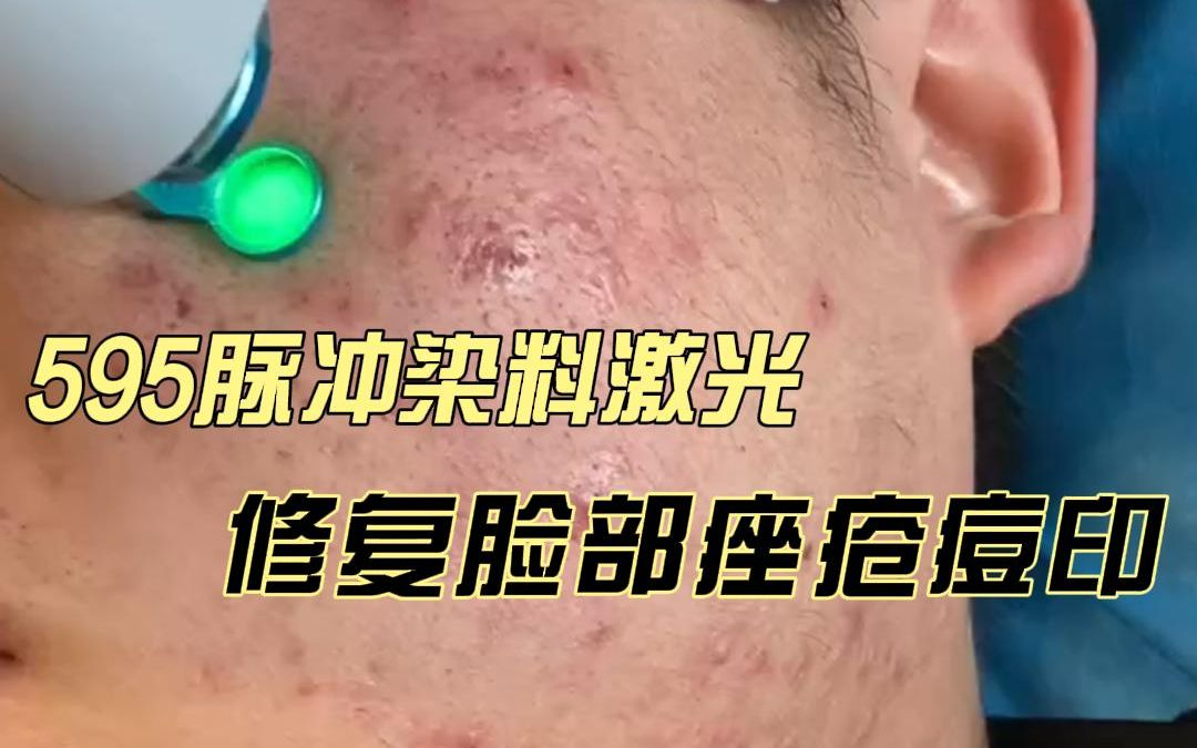595脉冲染料激光修复脸部痤疮痘印