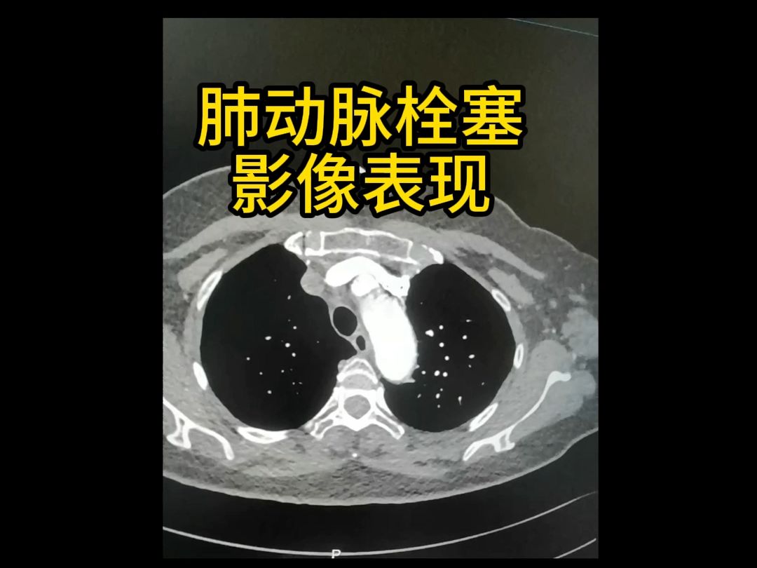 肺动脉栓塞影像表现CT读片要点哔哩哔哩bilibili