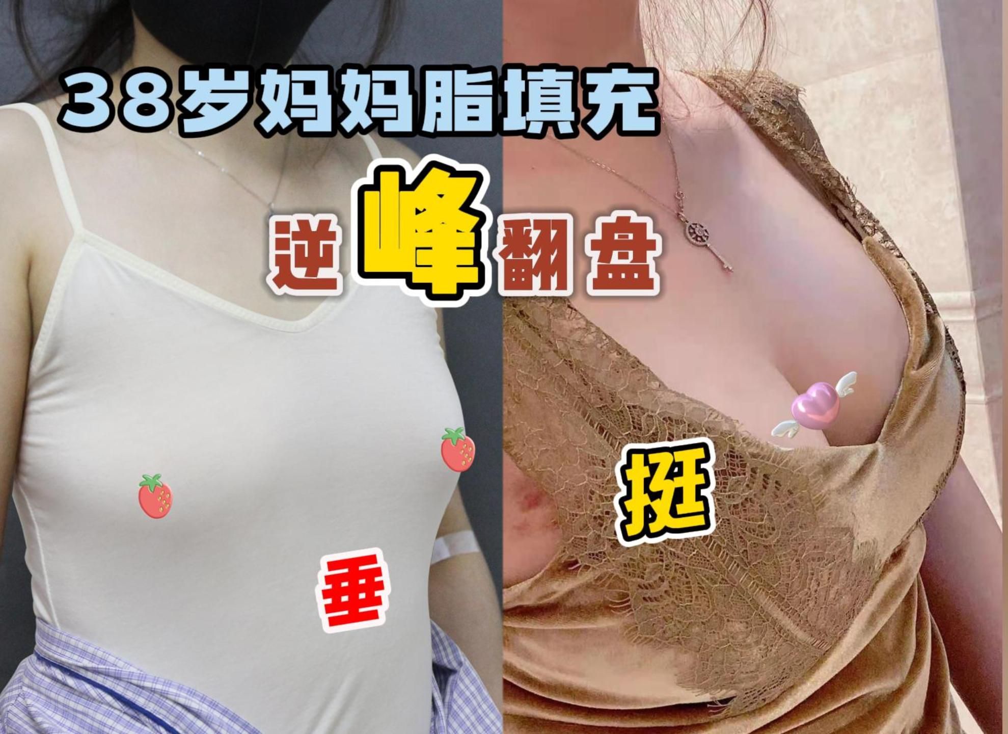 【李春财】产后胸部松垂 外扩 缩水 怎么办?自体脂肪填充后,形态变挺拔,柔软如天生哔哩哔哩bilibili