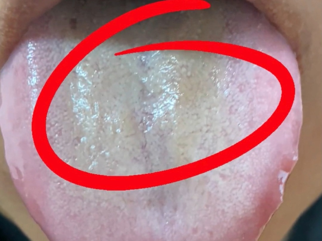 像这样的黄苔,切勿用寒凉药去清热