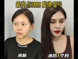 Download Video: 3mm的膨体眉弓，术后变化get到了吗