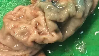 癌的恶性程度不能根据肿瘤外观来判断啊！这么像溃疡的一个癌灶，谁料想已经侵透全层！这就是溃疡型胃癌的特点！这对于胃镜医生取活检要求就高了，要精准取到癌灶才能诊断！