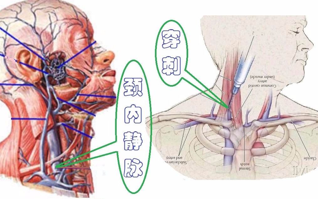 颈内静脉穿刺术哔哩哔哩bilibili