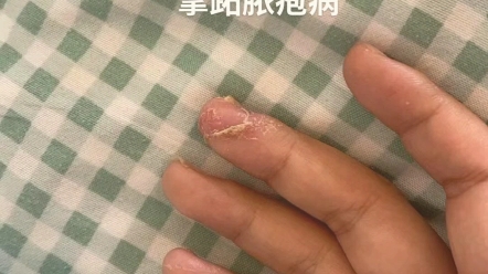 掌跖脓疱病的样子