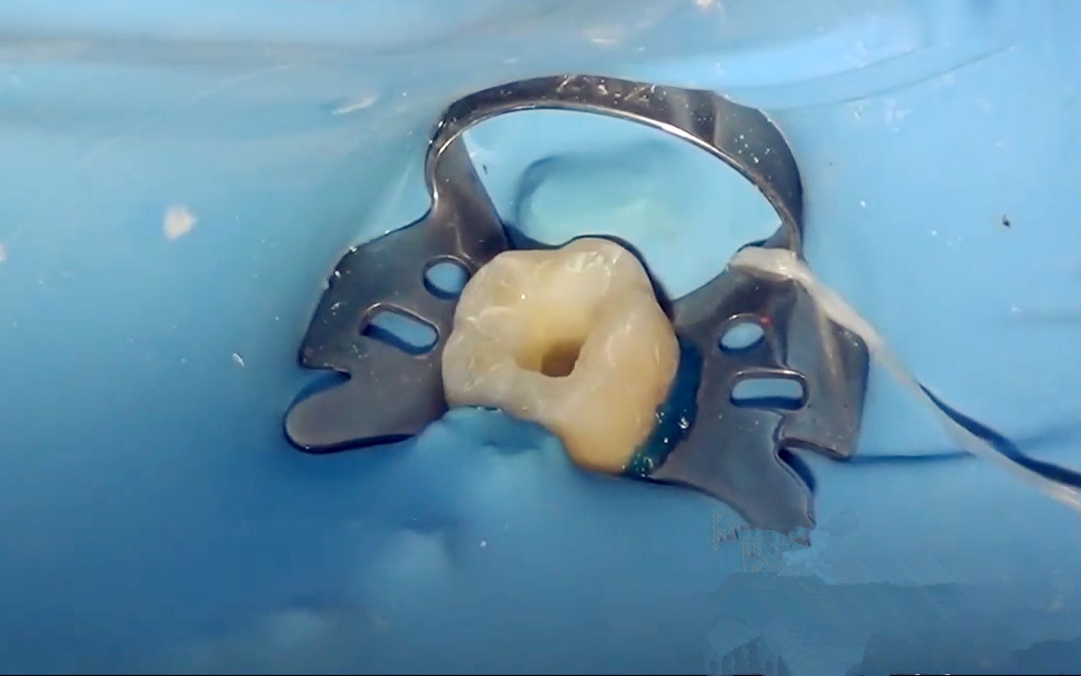 牙齿杀神经根管治疗全程受罪一点都不假说多了都是泪啊