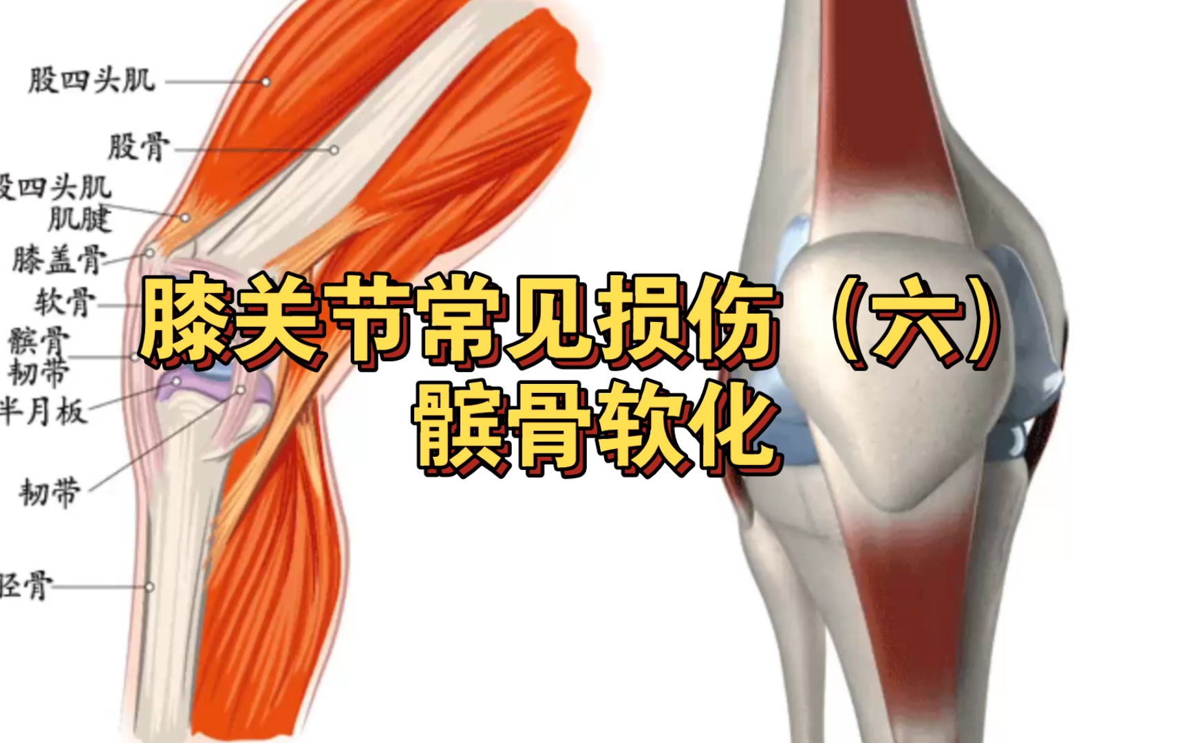 膝关节常见损伤(六)髌骨软化