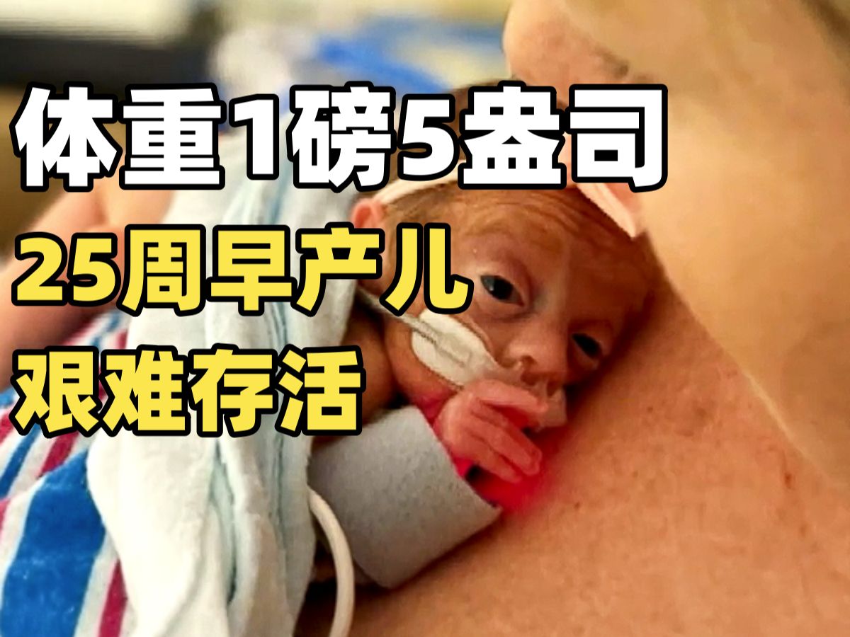 新奥尔良一25周早产儿出生时体重仅1磅5盎司 8个月后艰难存活 医生父母坚持未放弃哔哩哔哩bilibili