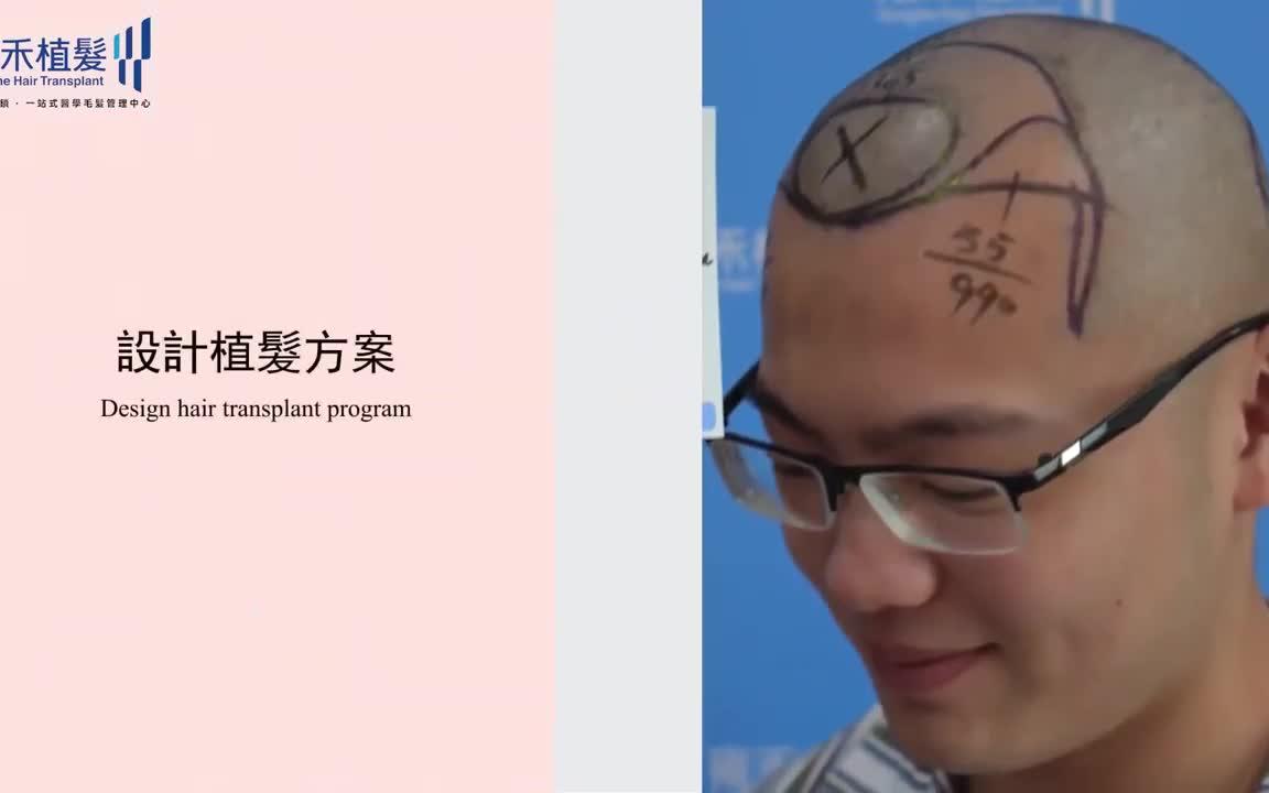 [图]FUE微針加密植髮效果曝光，親身經歷分享植髮心得！Yonghe hair transplant