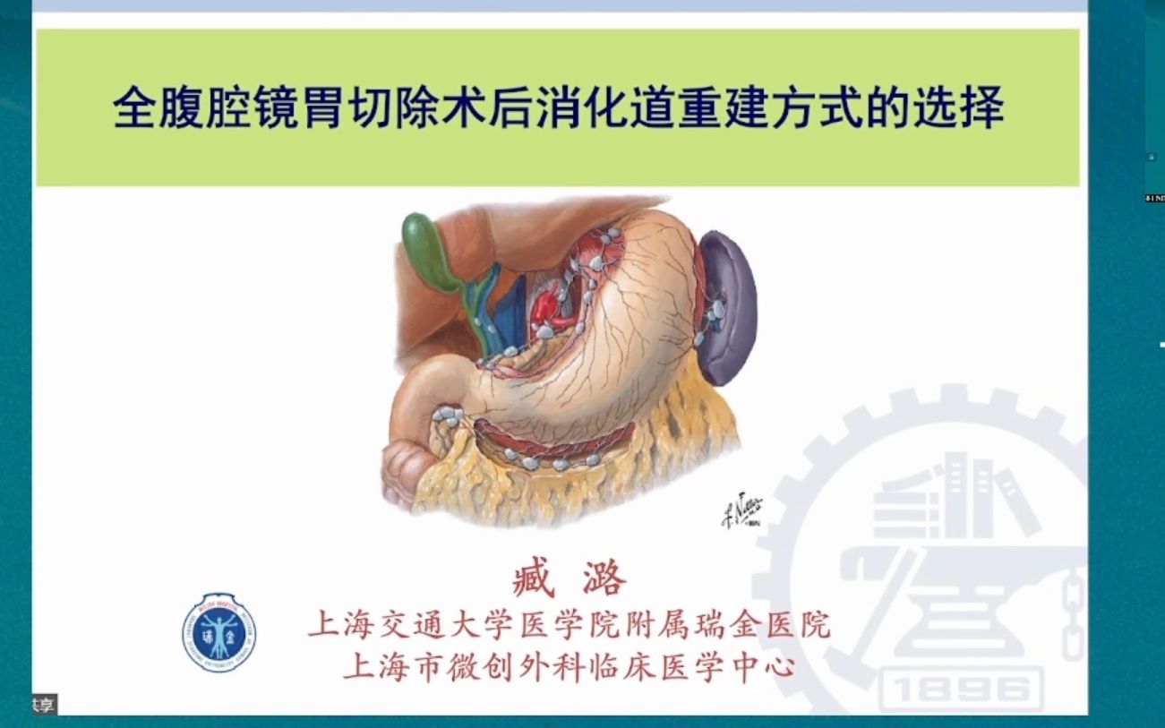 全腔镜下胃切除术后(近端、远端和全胃)的消化道重建方式选择哔哩哔哩bilibili