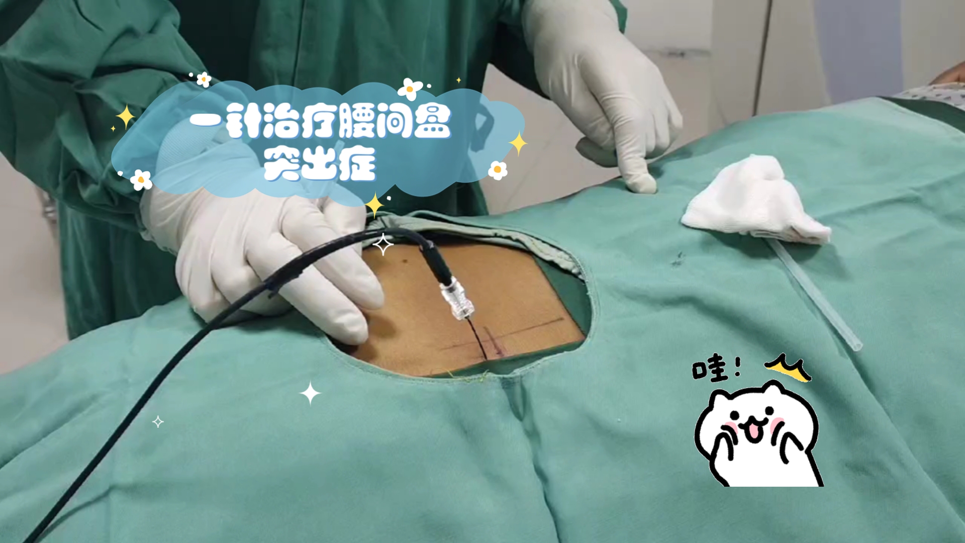 一针治疗腰间盘突出症(射频消融术)