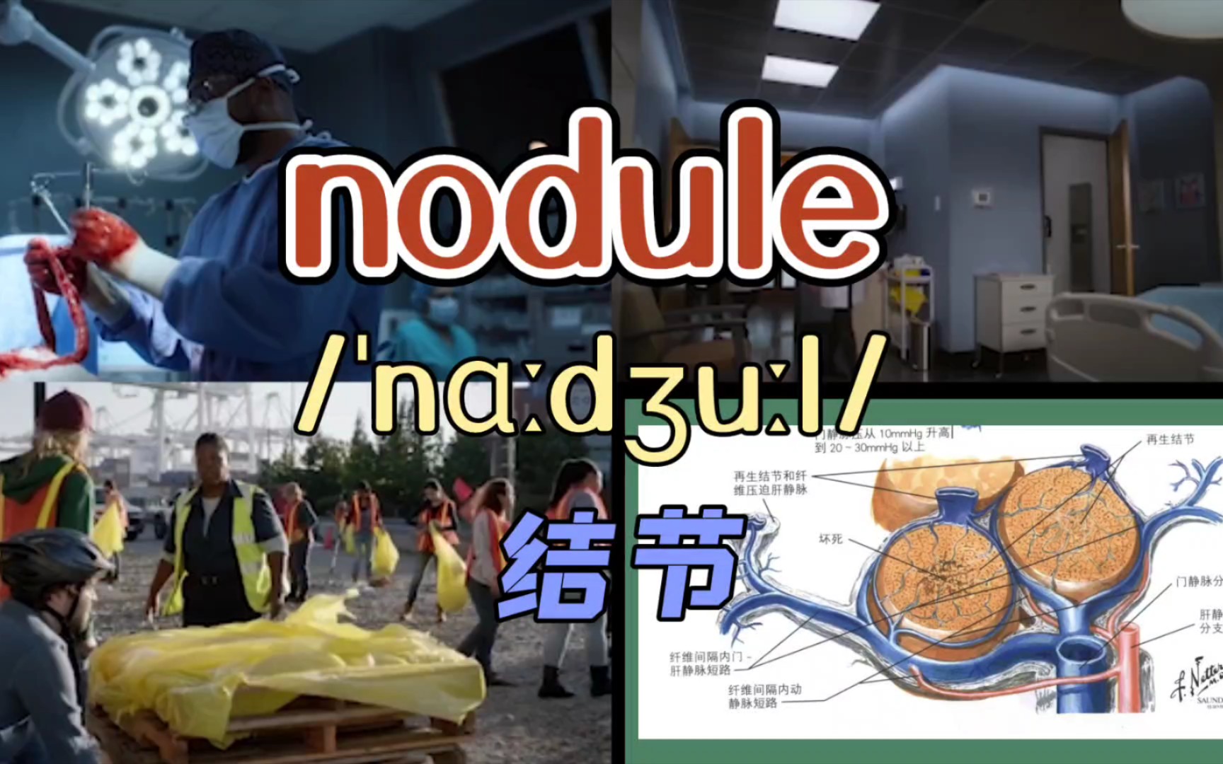 【医学词汇】nodule 结节哔哩哔哩bilibili