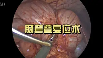 肠套叠复位术（非医学相关专业慎入）