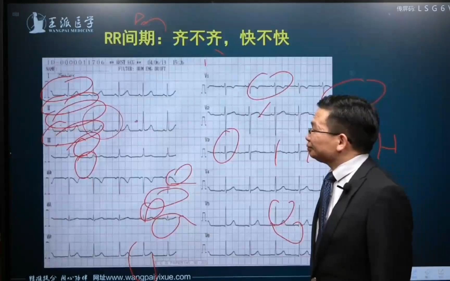 看心电图之前还有一步很关键的点:确定RR间期齐不齐?哔哩哔哩bilibili