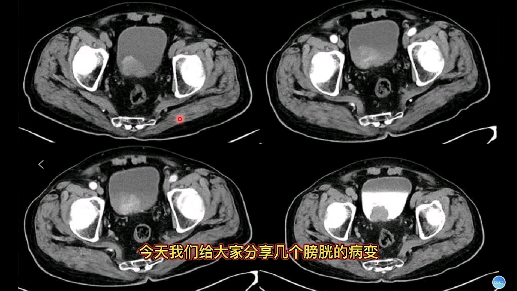 膀胱癌和慢性膀胱炎在CT上什么表现?放射科医生讲解哔哩哔哩bilibili