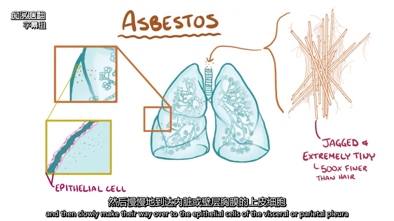 【医学科普】mesothelioma - causes, symptoms, diagn
