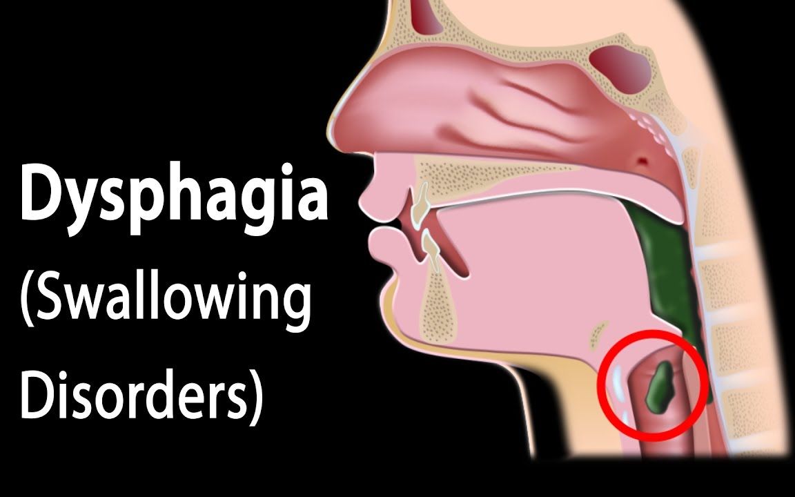 进行性吞咽困难图片