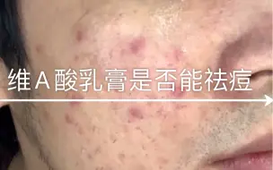 Tải video: 维A酸乳膏1-6天测评