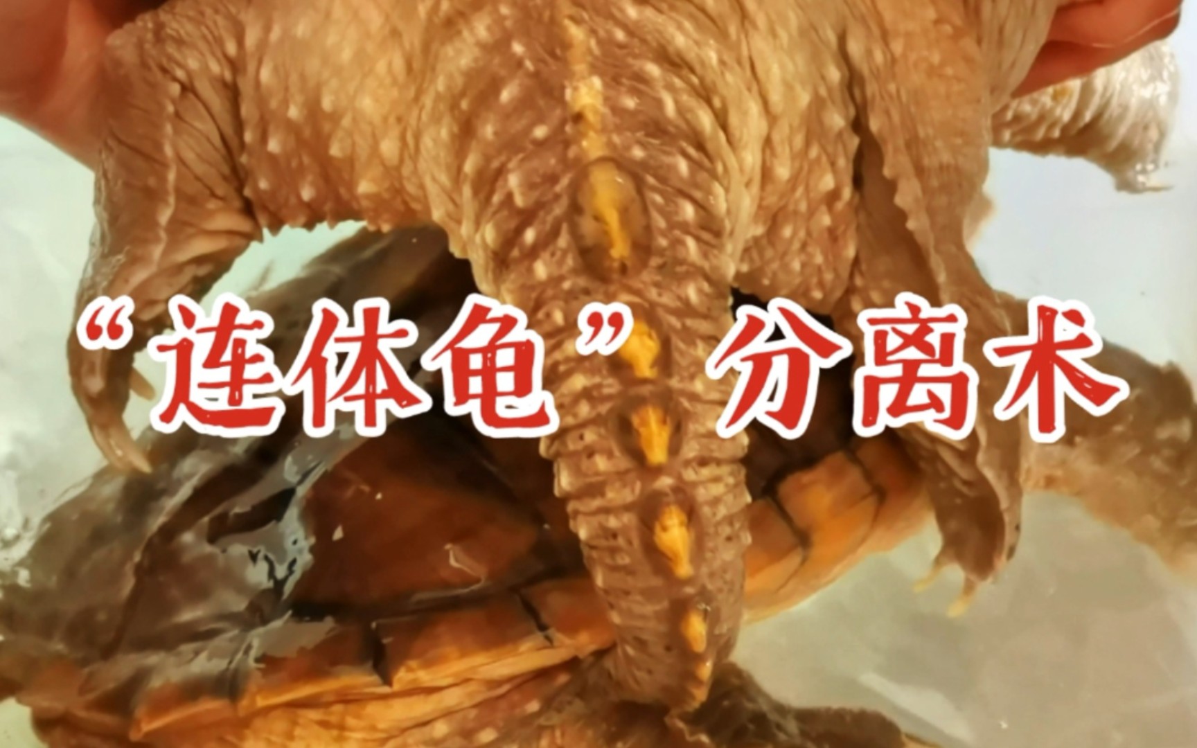 "连体龟"分离术