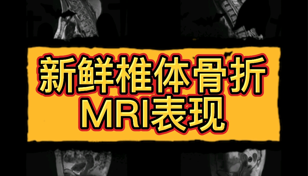 新鲜椎体骨折在MRI上什么表现?实际病例分享,动态图像观察哔哩哔哩bilibili