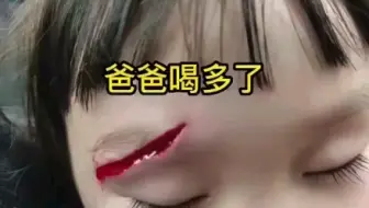 因为爸爸喝醉了没有站稳，撞倒女儿磕到桌角，担心留疤爸爸也愧疚了很久，还好遇到了我们，最终没有留下任何痕迹和遗憾 ，这位爸爸从此也戒酒了。