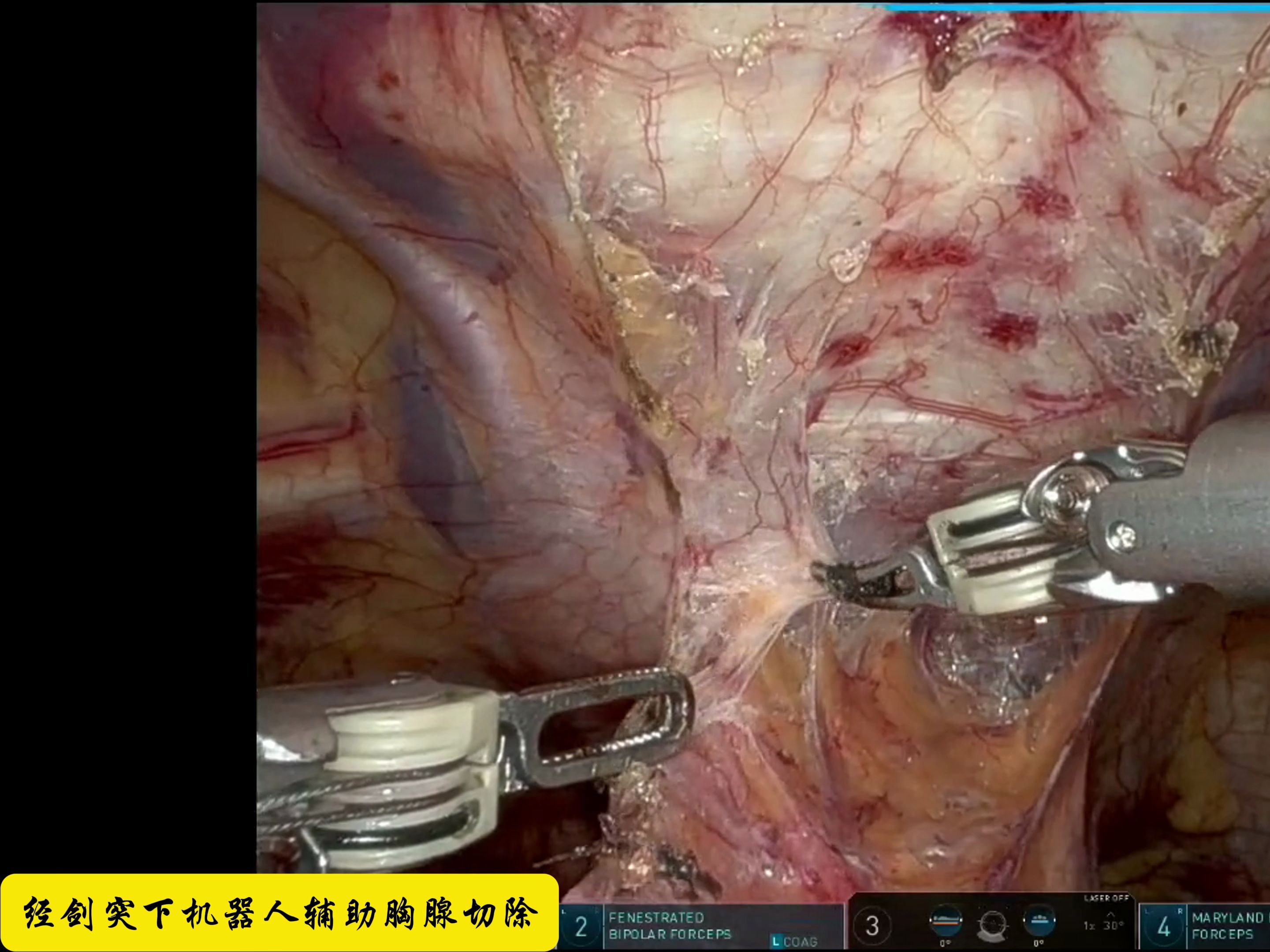 【手术】经剑突下机器人辅助胸腺切除哔哩哔哩bilibili