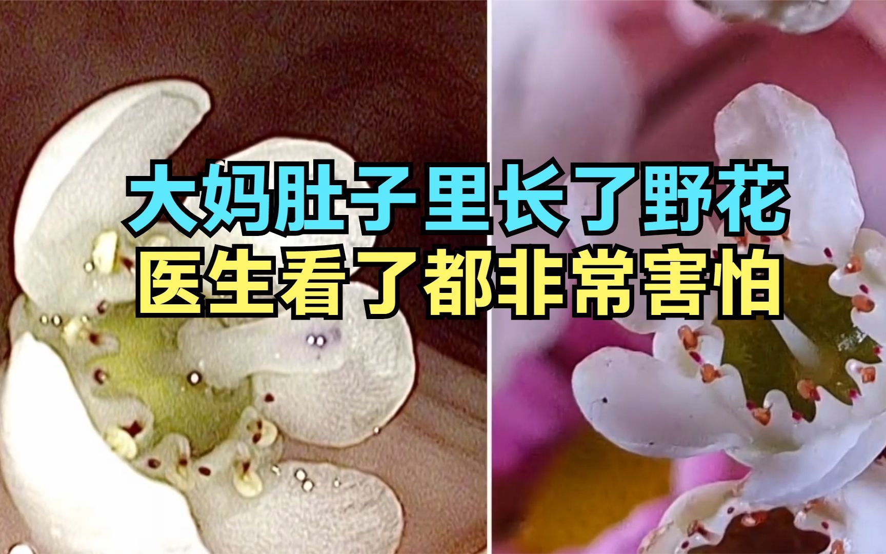 [图]大妈肚子里竟然长出一朵花，把医生都吓了一跳