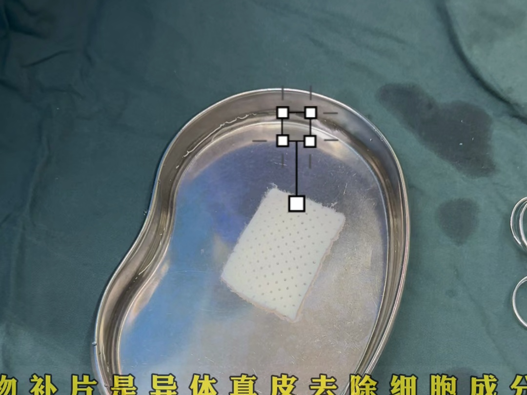 生物补片阴j植入增粗的同时改善早泄