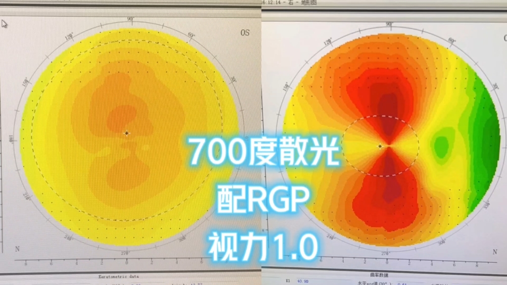 700度散光配角膜接触镜rgp矫正视力1.