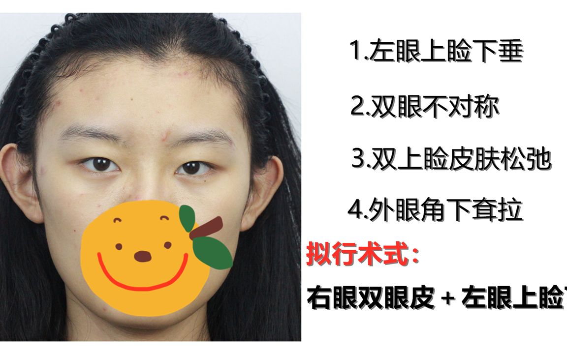 姑娘在校大学生 双眼不对称 外眼角下耷拉明显