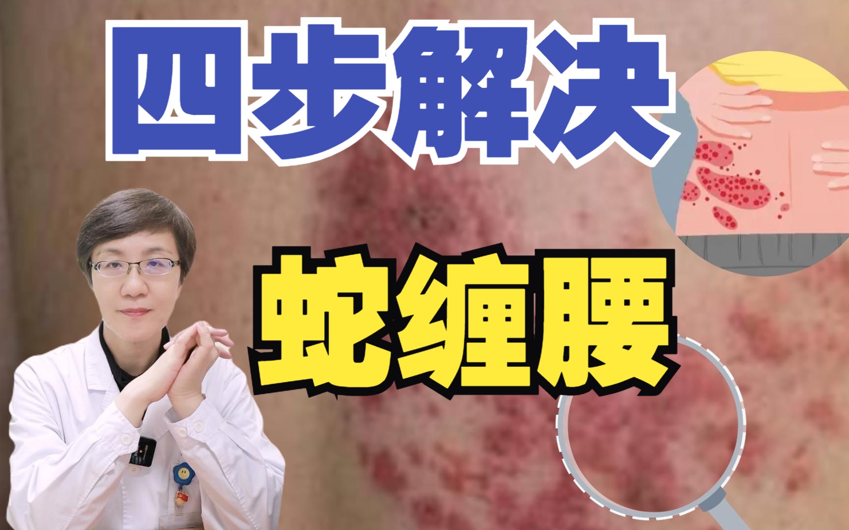 比十级生育还要痛的蛇缠腰,你都了解吗?医生教你怎么四步进行处理!