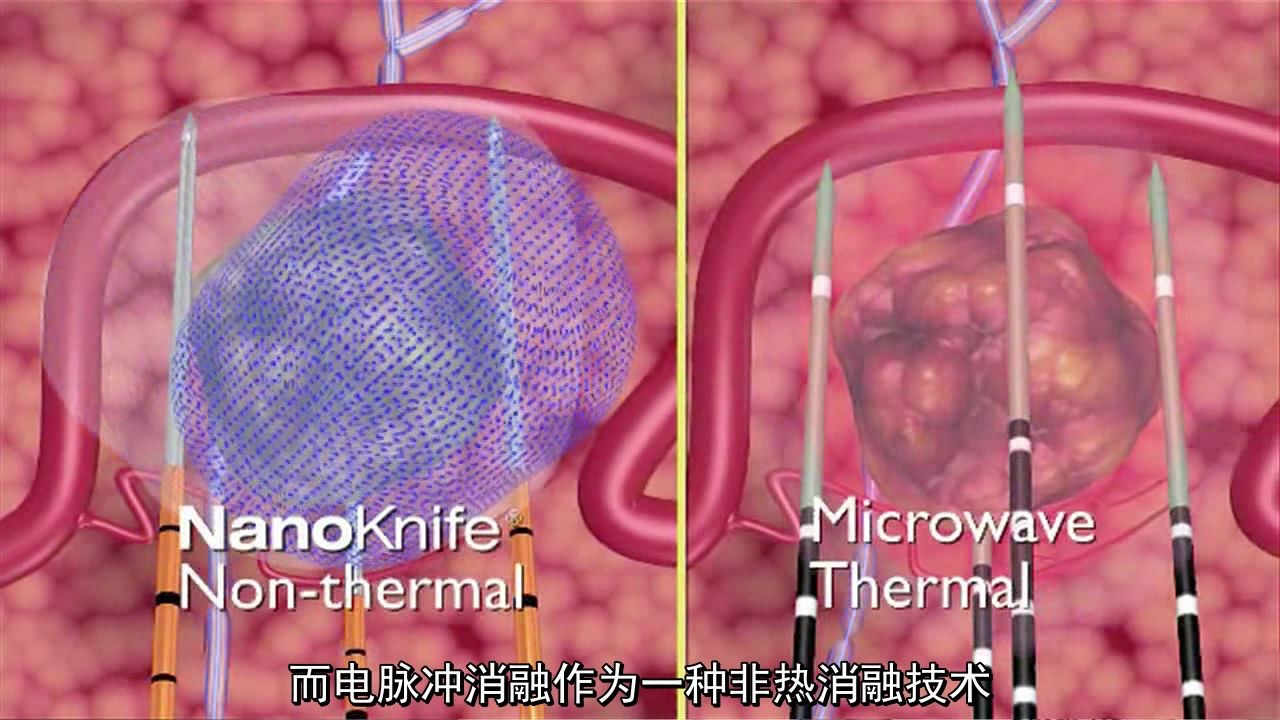 纳米刀超短高压脉冲电场肿瘤消融技术哔哩哔哩bilibili