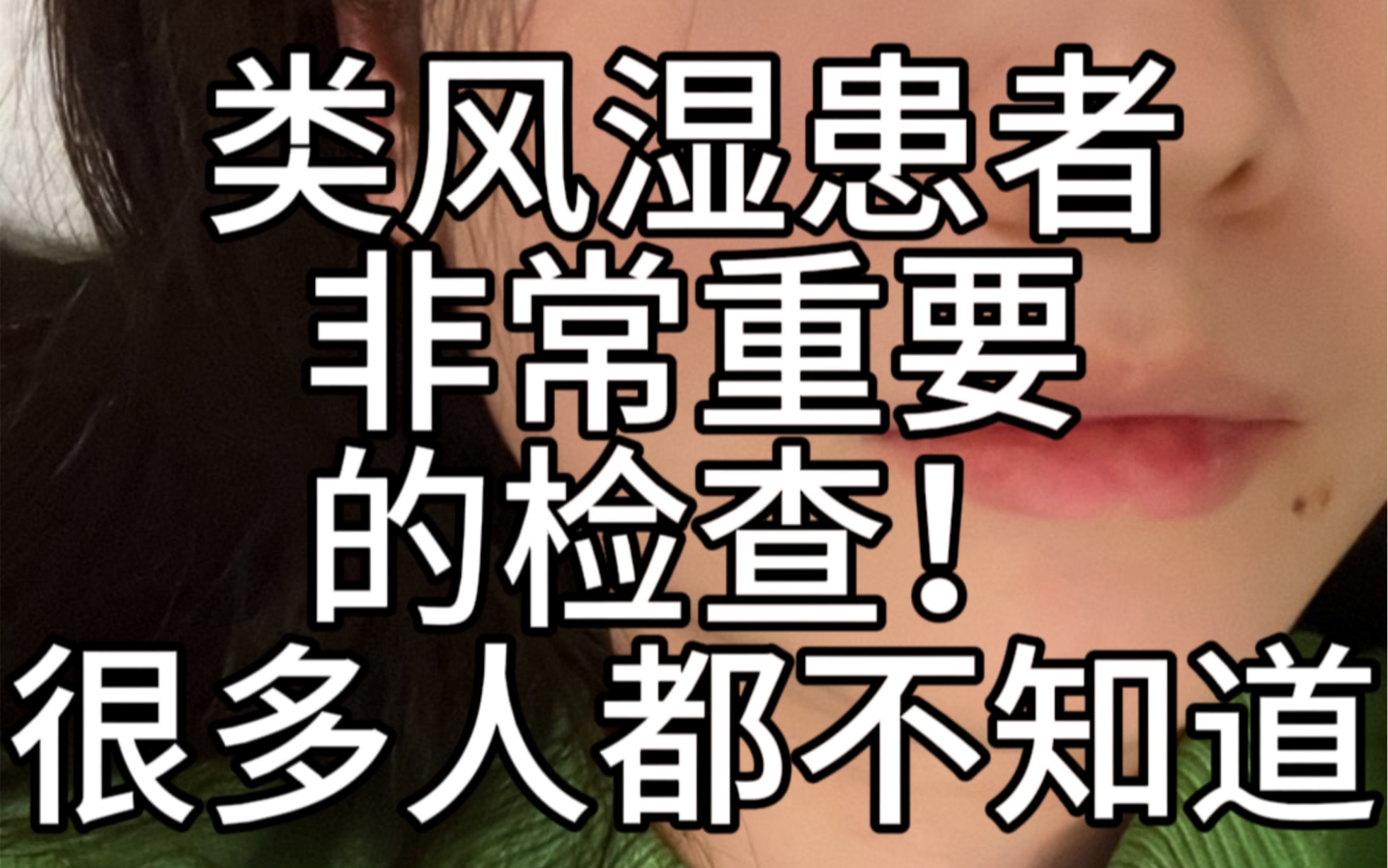 类风湿患者去医院还应该去哪个科室?哔哩哔哩bilibili