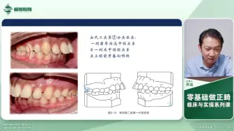 Download Video: 第七章:错颌畸形的分类和方案设计——靳磊零基础学正畸