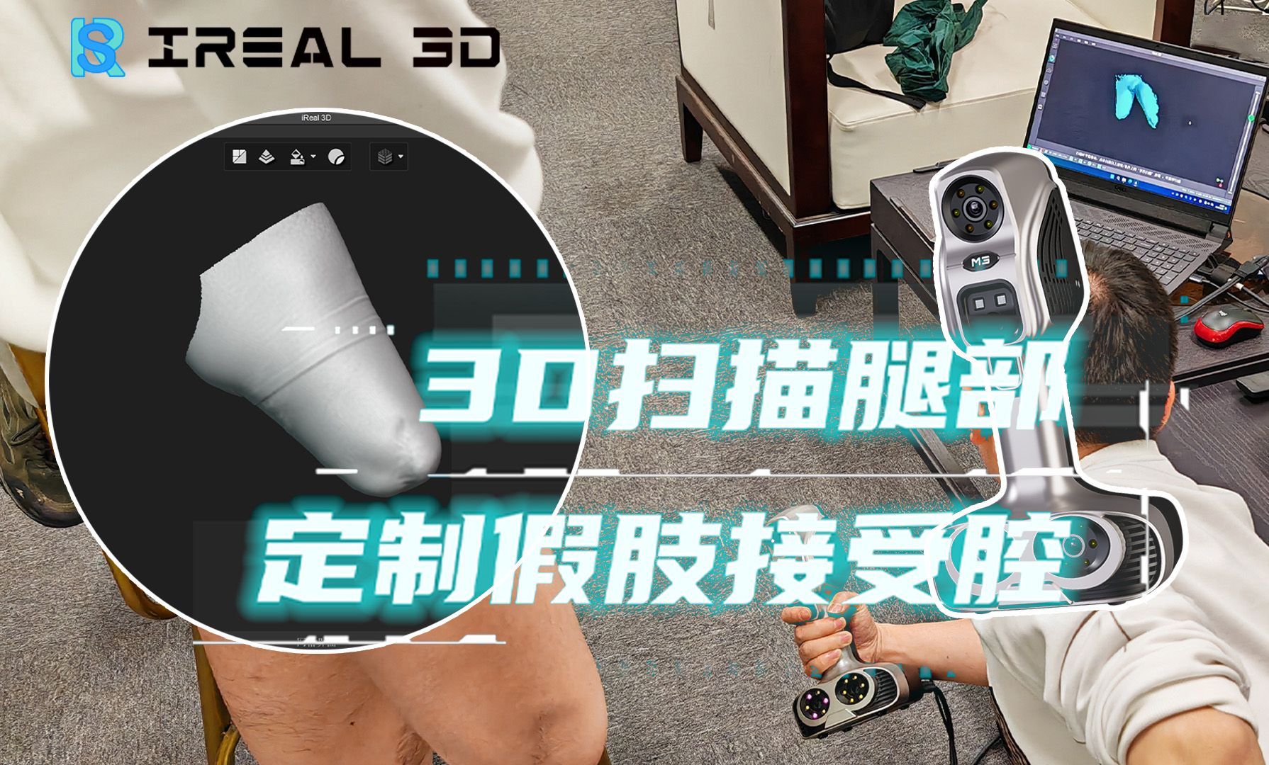 【数字医疗康复】iReal 3D三维扫描助力个性化医疗定制,3D打印假肢接受腔哔哩哔哩bilibili