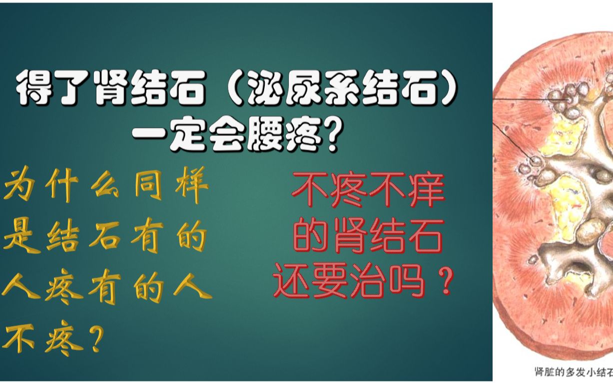 得了肾结石(泌尿系结石) 一定会腰疼?为什么同样是结石有的人疼有的人不疼?不疼不痒 的肾结石 还要治吗?哔哩哔哩bilibili