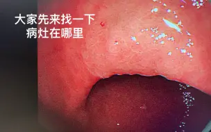 Download Video: 早期胃癌，长什么样子？竟然如此因此隐蔽