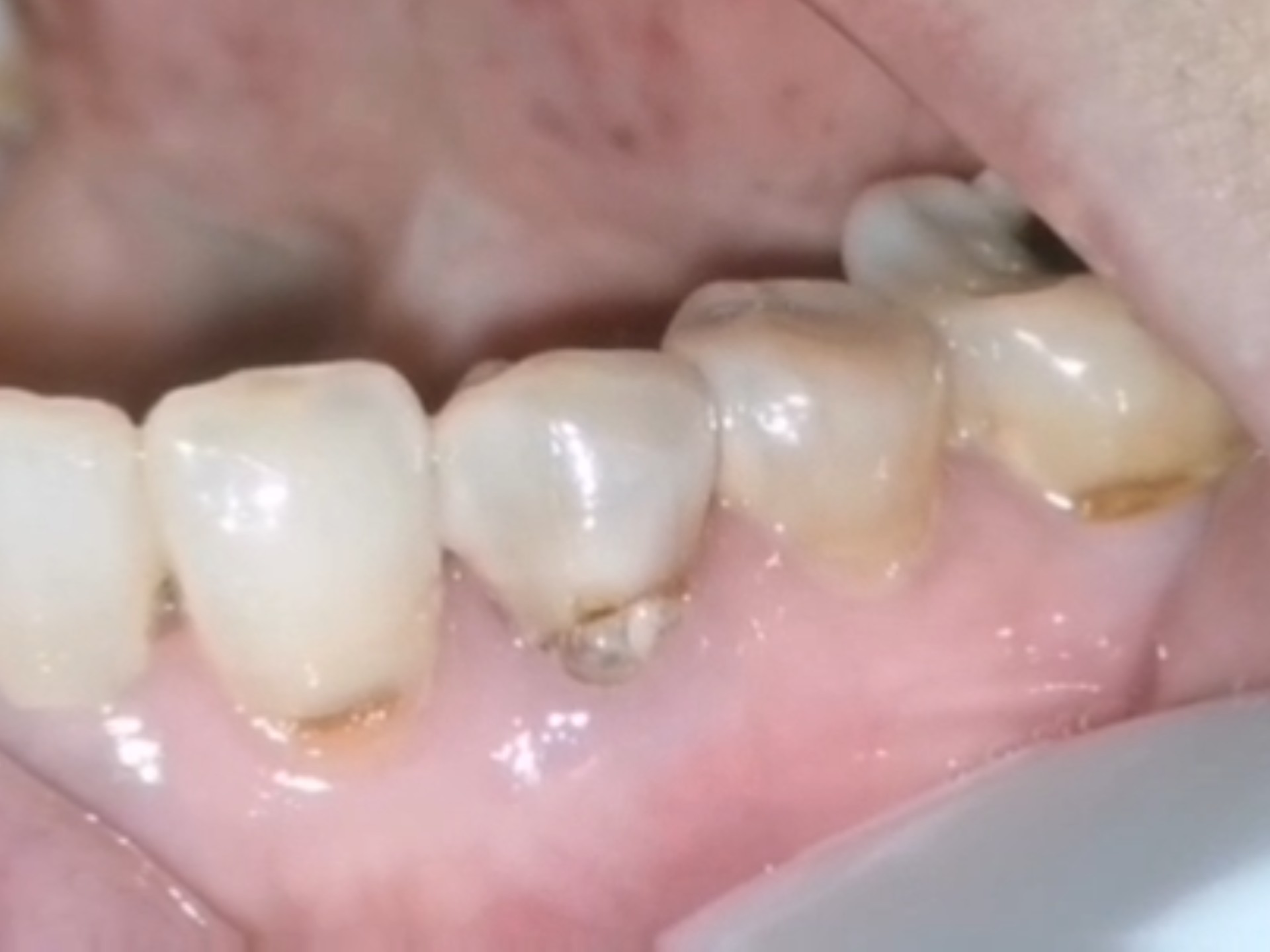 牙根上坏个大洞,清理干净,根管后树脂修复起来!