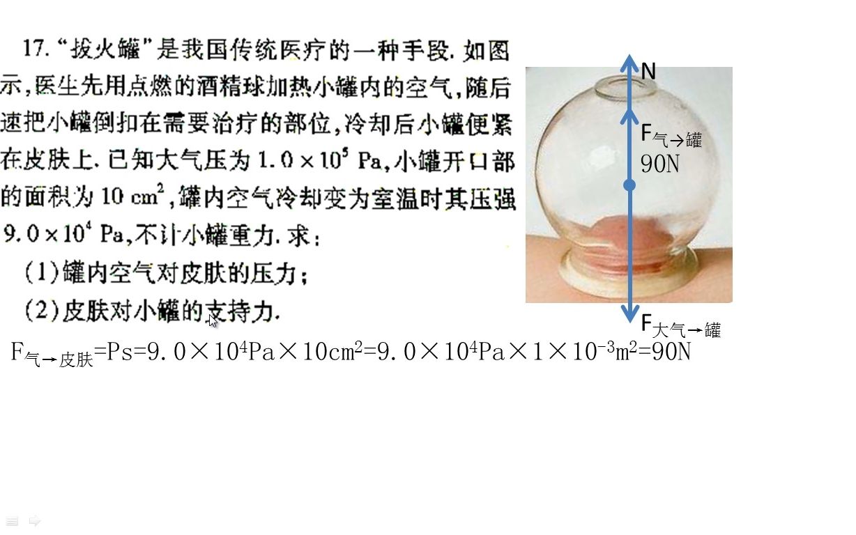 压强气压题(“拔火罐”是我国传统医疗的一种手段.如图所示,医生先用点燃的酒精球加热小罐内的空气,随后迅速把小罐倒扣在需要治疗的部位,冷却后...