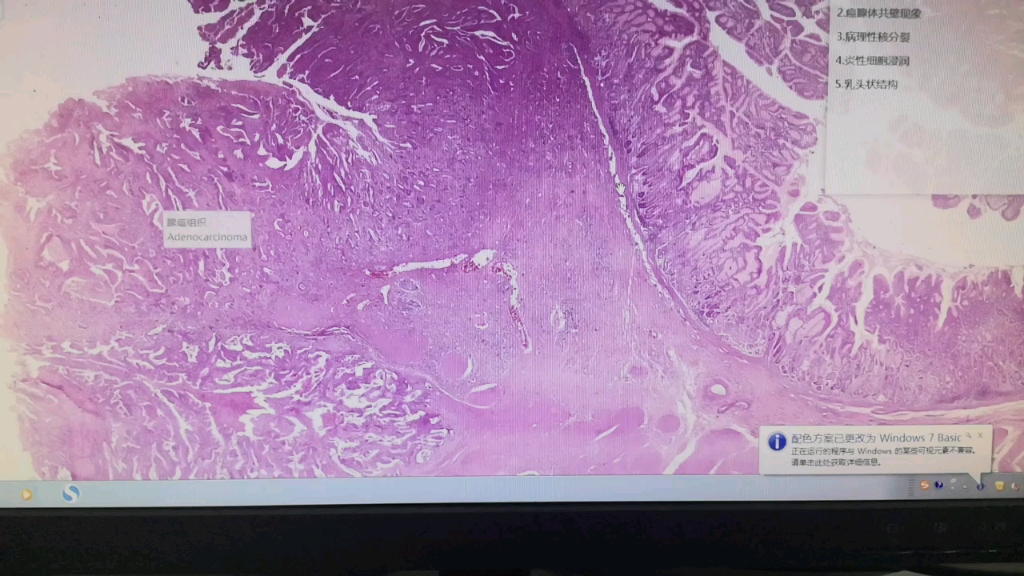 病理切片 腺癌和骨肉瘤(自用)哔哩哔哩bilibili