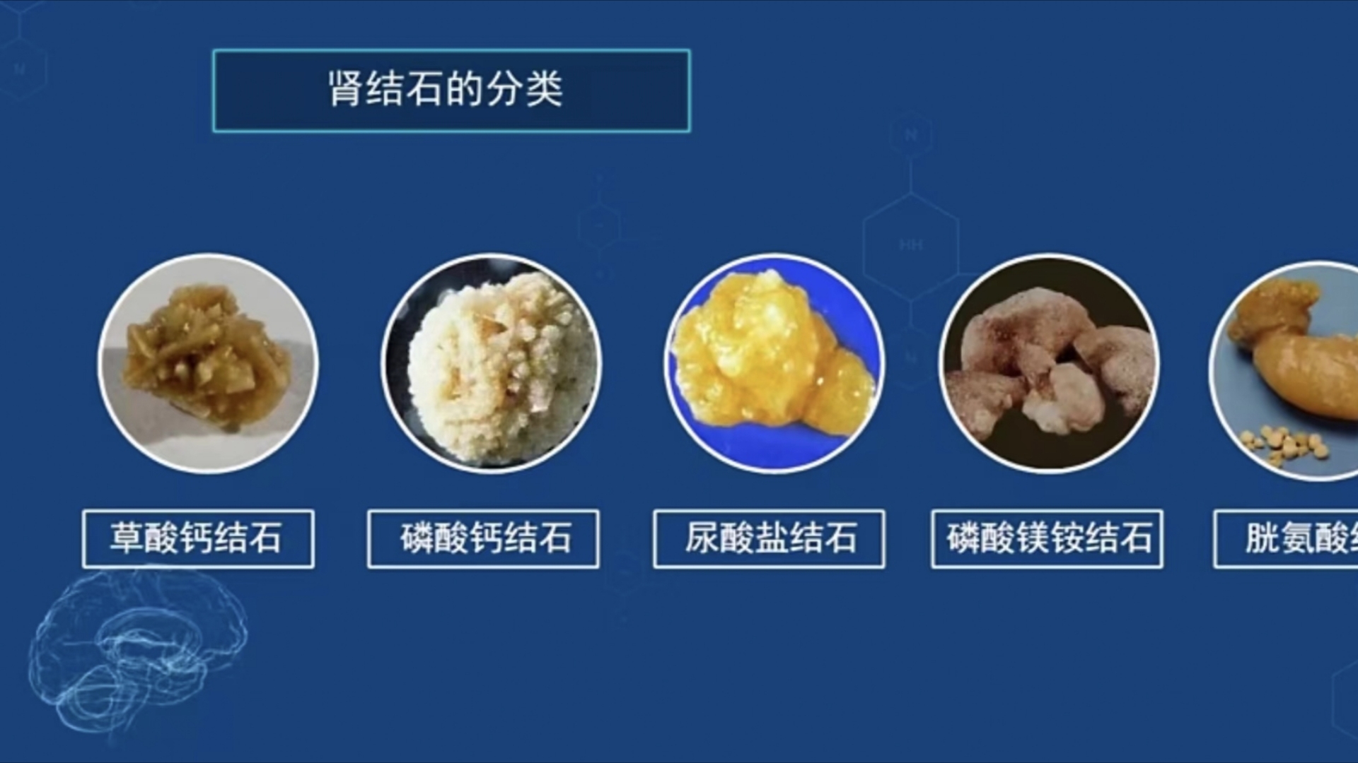 尿结石严重吗图片