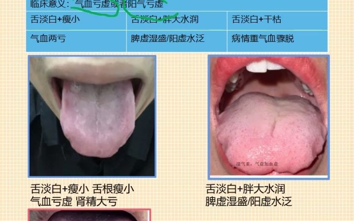 舌诊系列,第14讲淡白舌的意义哔哩哔哩bilibili