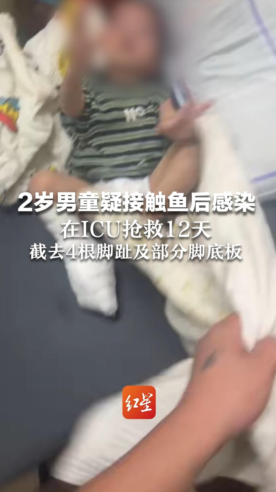 2岁男童疑接触鱼后感染致命弧菌 在ICU抢救12天 截去4根脚趾及部分脚底板哔哩哔哩bilibili