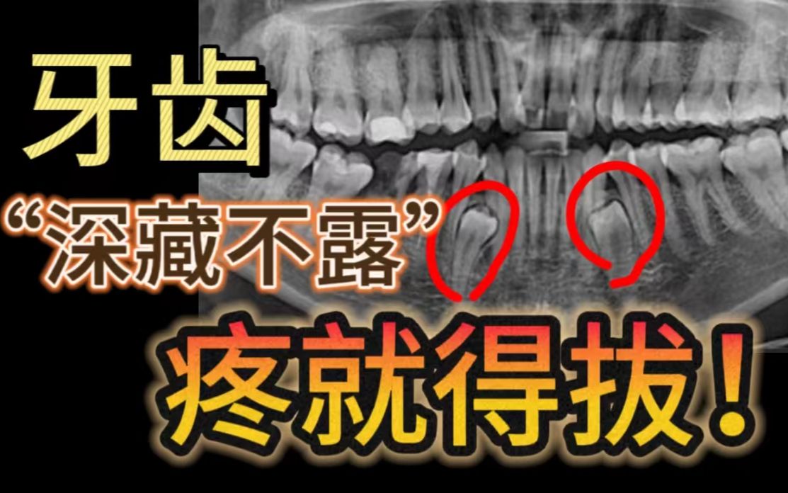 长了埋伏牙,一个牵连俩,埋伏牙不拔,小心全口拔!