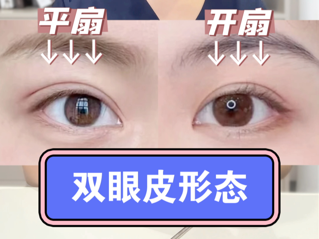 四种双眼皮形态,你适合哪种?哔哩哔哩bilibili