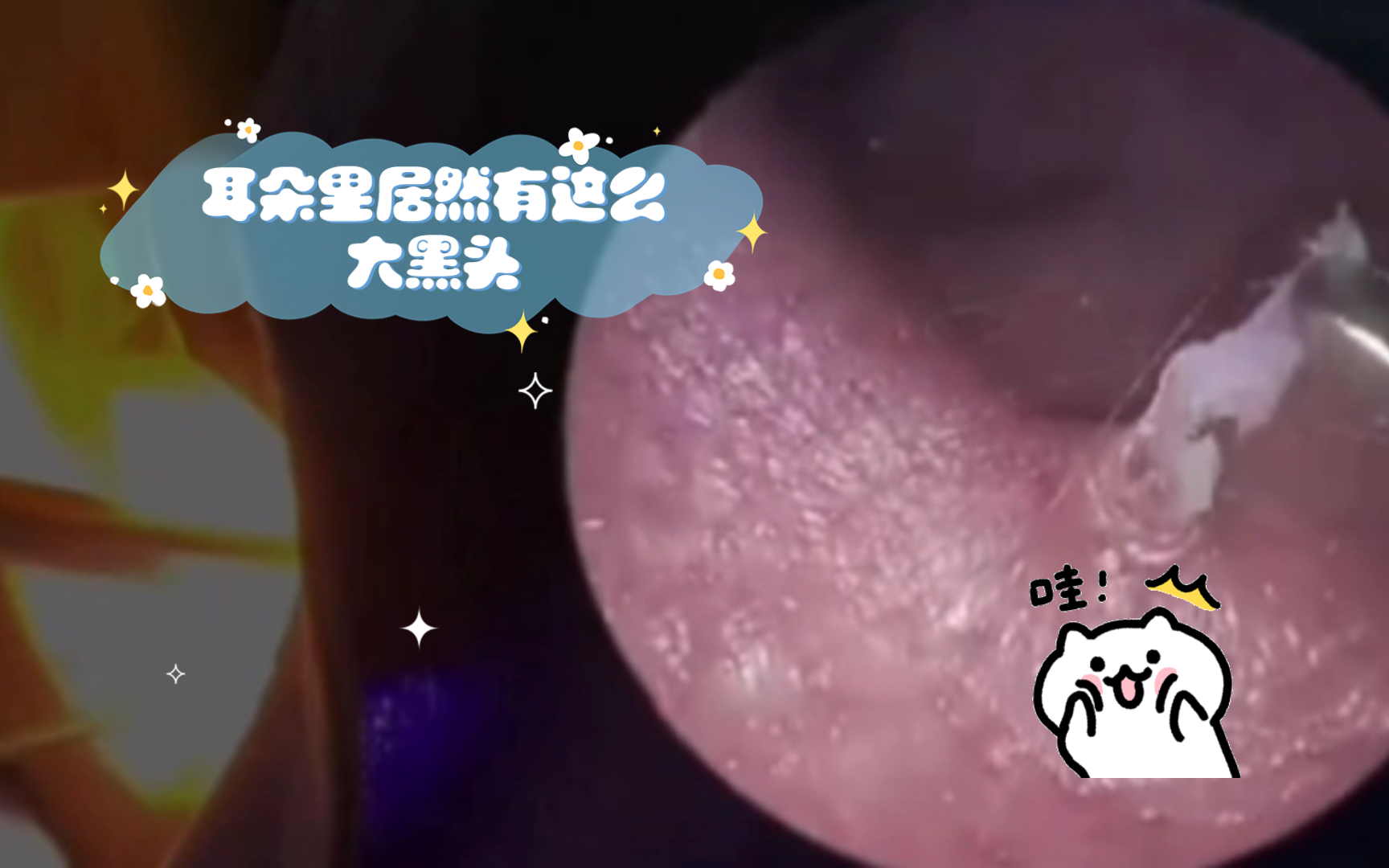 震惊!耳朵里居然有这么大黑头