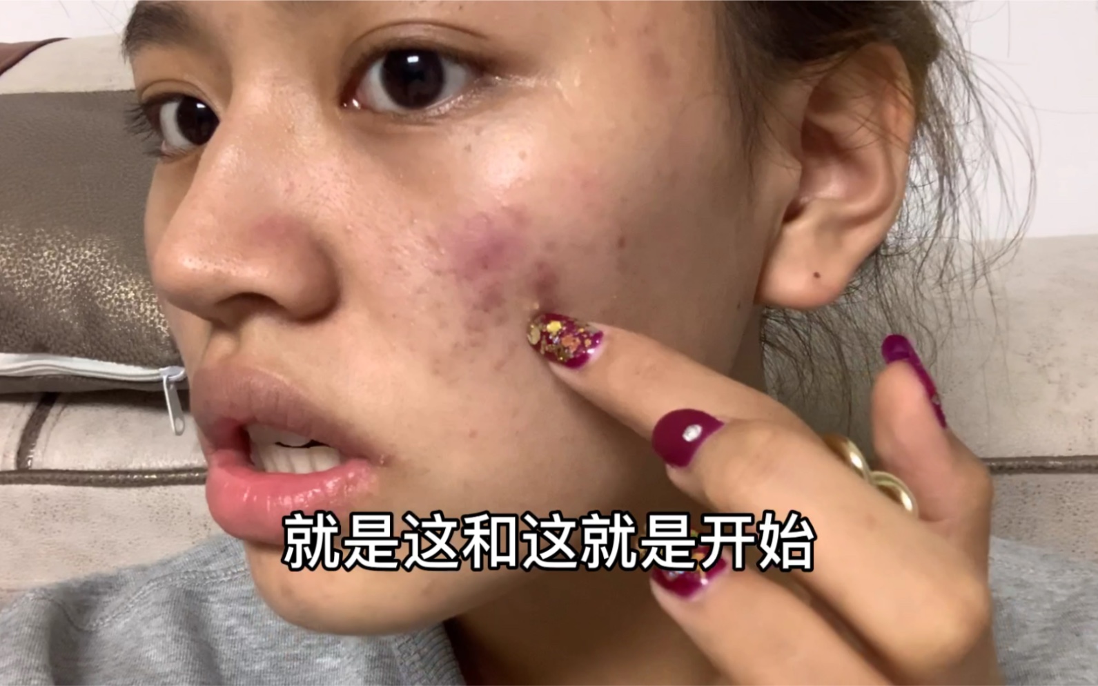 原相机烂脸的开始刷酸已证实无效