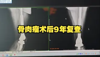 Descargar video: 股骨骨肉瘤术后8年复查，一切正常，要注意控制体重和运动量。风雨过后，会见彩虹！