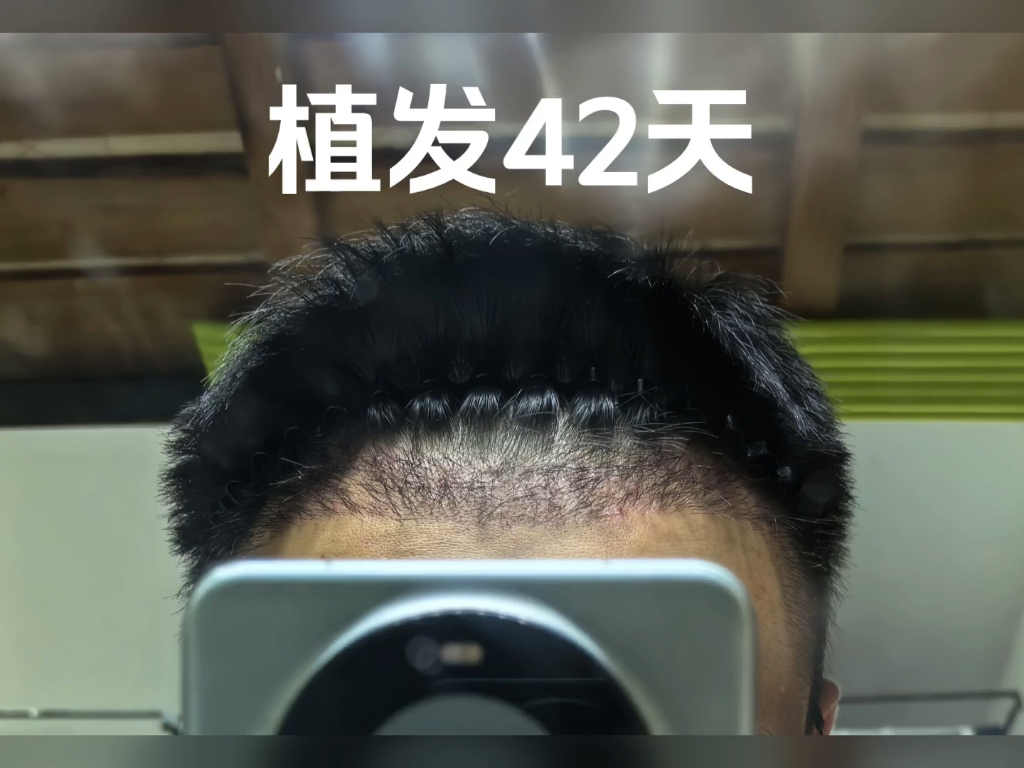 植发会全部脱落后再长吗(植发会全部脱落后再长吗图片)