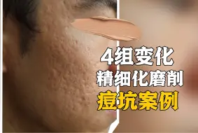 Descargar video: 厢车型痘坑精细化磨削后的羽化效果，案例实况记录